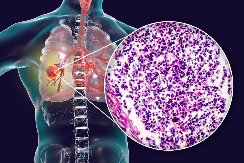 Η διάγνωση του καρκίνου του πνεύμονα 1 από την Lung Cancer.