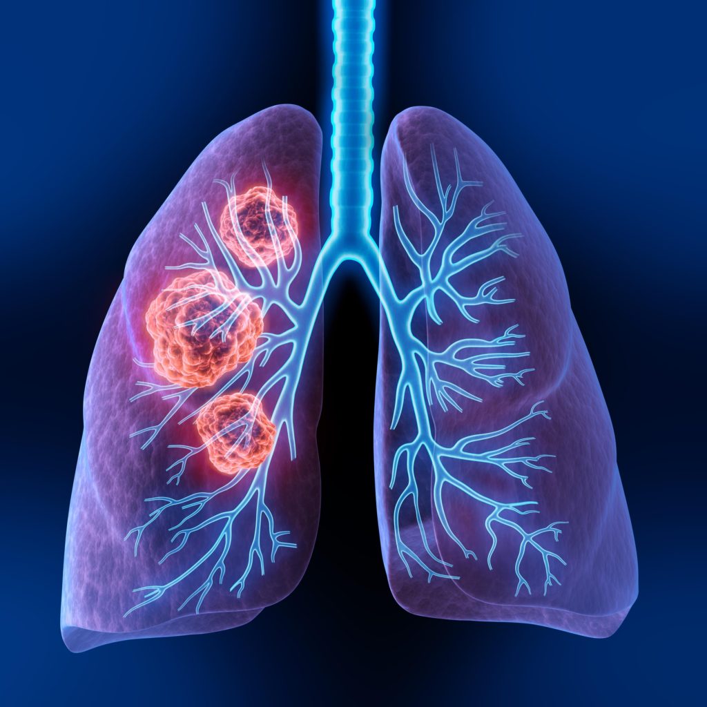 Συχνές ερωτήσεις για τον καρκίνο του πνεύμονα 1 και οι απαντήσεις τους από την Lung Cancer.